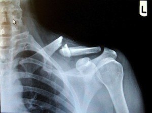 gebroken-sleutelbeen