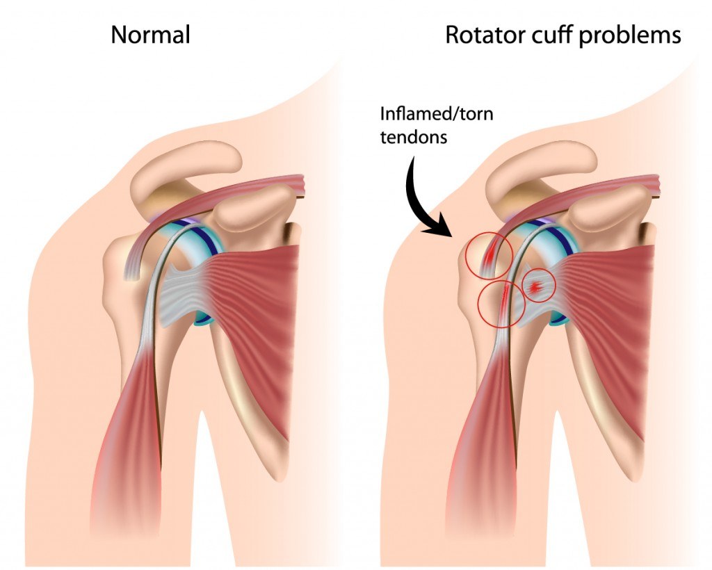 Rotator-cuff