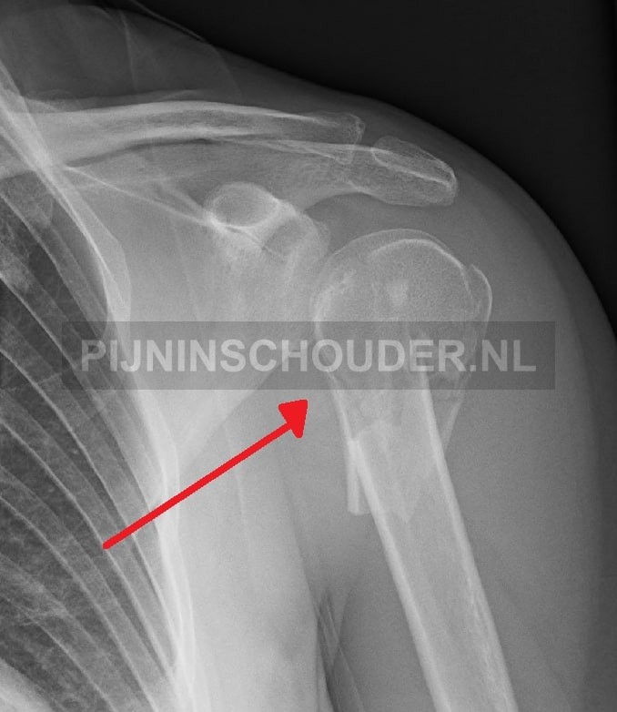 Röntgenfoto van een breuk in de bovenarm bij de schouder