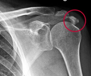 tendinitis calcarea