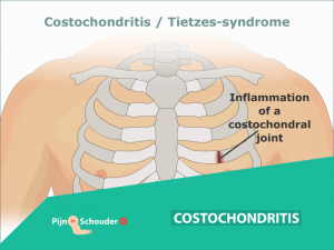 costochondritis