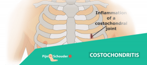 costochondritis