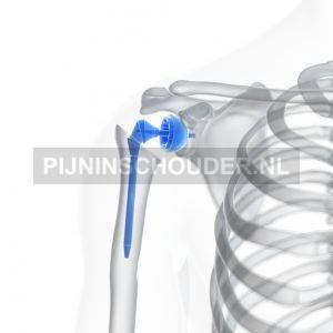 Schouder prothese - nieuwe schouder
